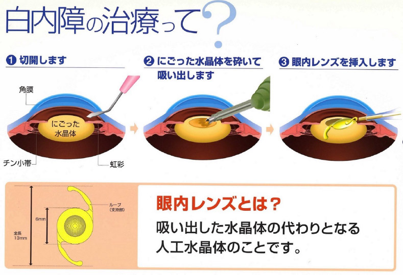 白内障の手術について - 医療法人 広田眼科医療法人 広田眼科