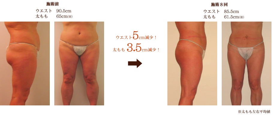 キャビテーションとは|AromaHealing Luxe