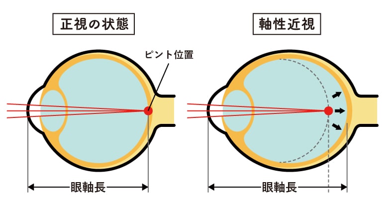 MYOPINE 近視進行抑制治療薬「マイオピン」 - KURIYAMA EYE CLINIC