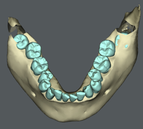 歯を抜かない「非抜歯」矯正治療はどんな場合ができるのか - 【公式