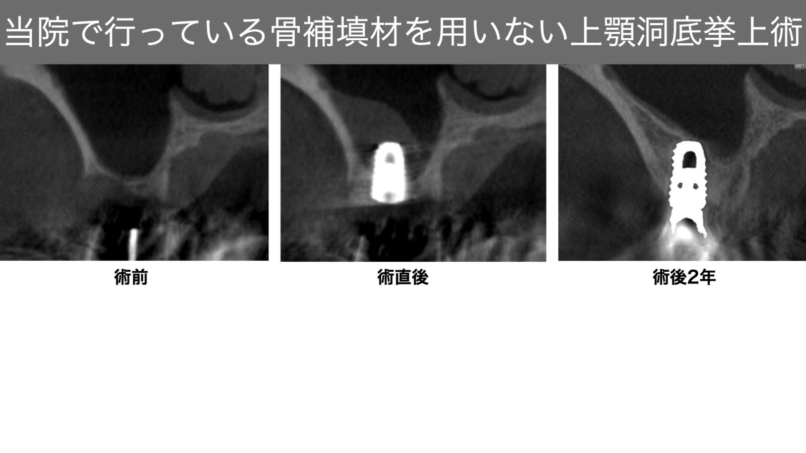 上顎洞底挙上術①