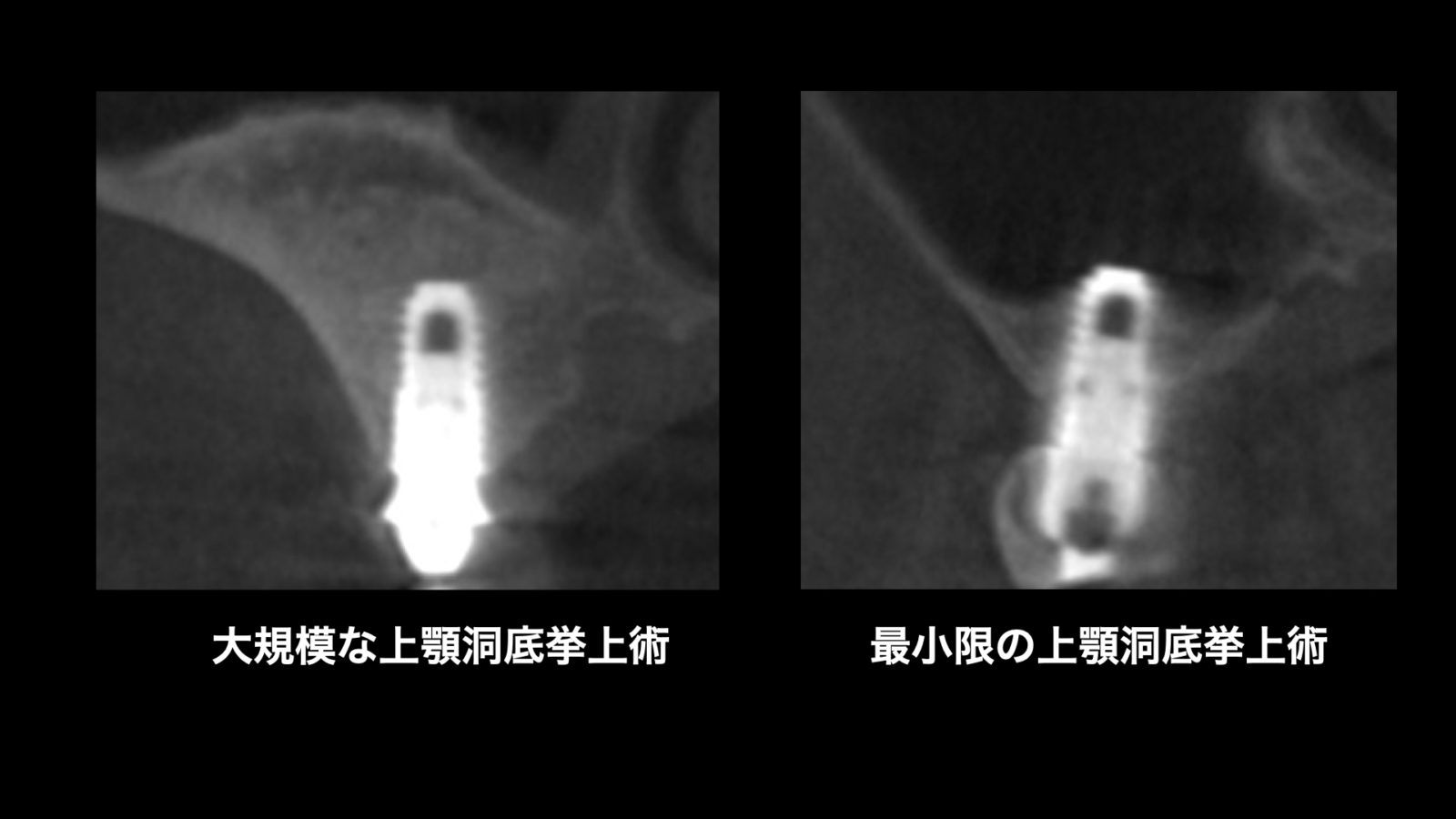 上顎洞底挙上術②