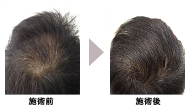 増毛エクステ Duo Hair | 東京 新宿 渋谷