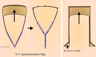 11/01/16 依頼原稿／局所皮弁法(3) | 形成外科医のアメリカ留学計画