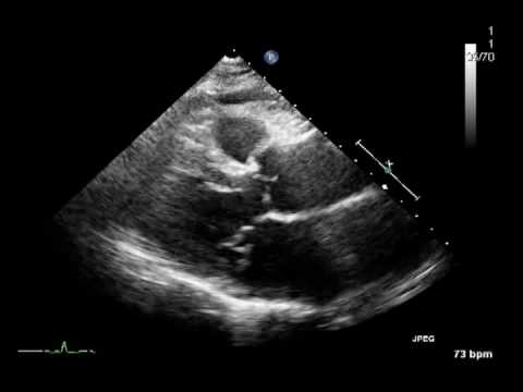 心エコーによる僧帽弁逆流の重症度評価と問題点 | 「心臓」特別号「僧
