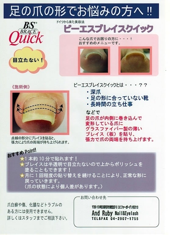 巻き爪矯正メニュー導入しました♡】 | 所沢のネイル＆まつげ専門