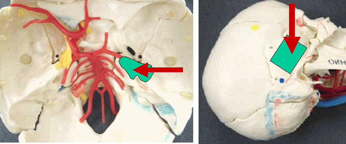 聴神経腫瘍の手術法