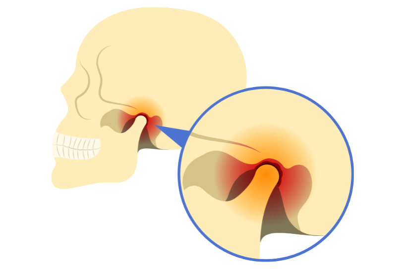 顎関節症治療 | アール歯科・矯正歯科クリニック