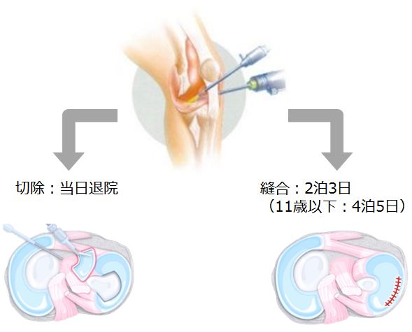 半月板 | あんしん病院
