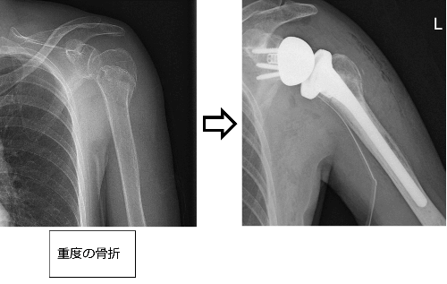 リバース型人工肩関節(RSA)について／藤枝市立総合病院
