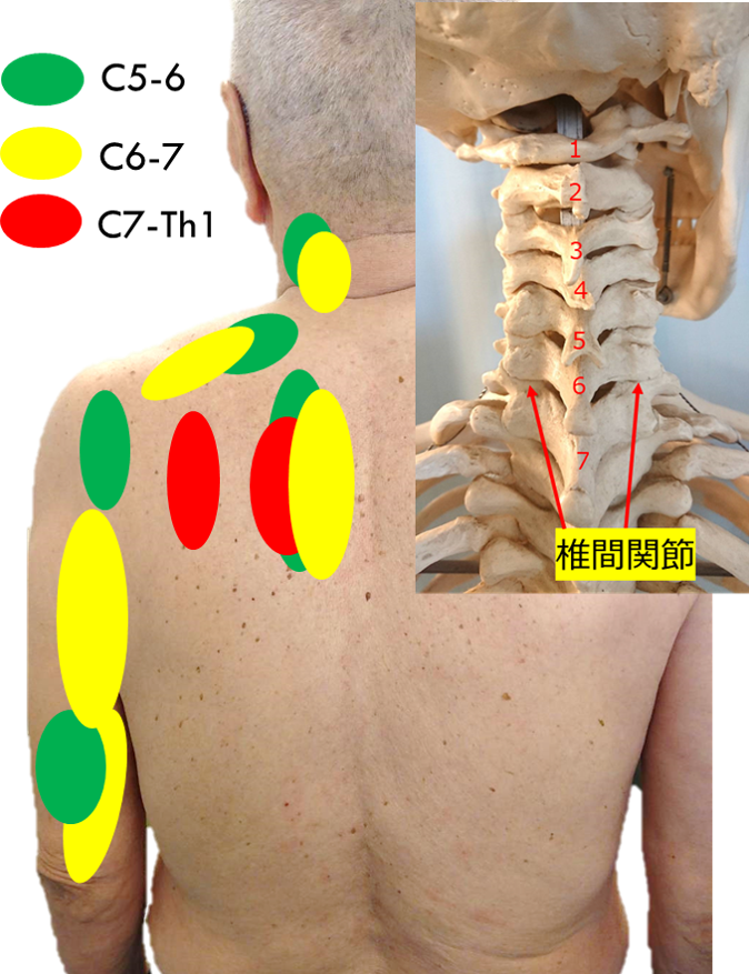首の寝違え、何度も繰り返すのはなぜ？原因と対策を徹底解説【平野区