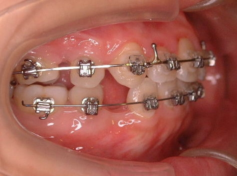 KAZ矯正歯科でバンドを使用しない理由 | KAZ矯正歯科ブログ | 千代田区