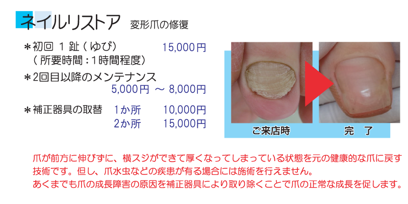 ペディグラステクノロジー｜ネイルリストア（変形爪の修復） 施術料金