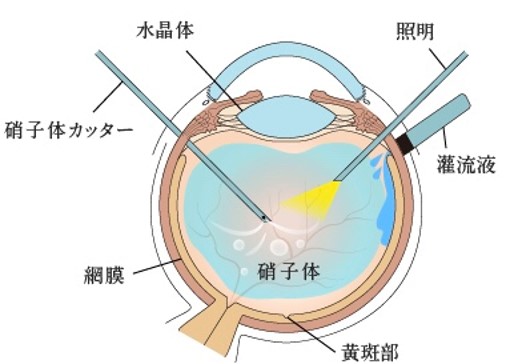 日帰り網膜硝子体手術について」 | 医療法人社団 真愛会