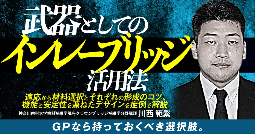 歯に優しいけどムズかしい、接着ブリッジの臨床論。デザイン・形成の