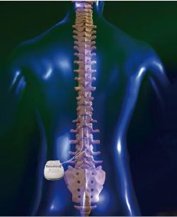 SCS脊髄刺激療法 - 【公式】豊岡第一病院 -医療法人社団 宏志会-