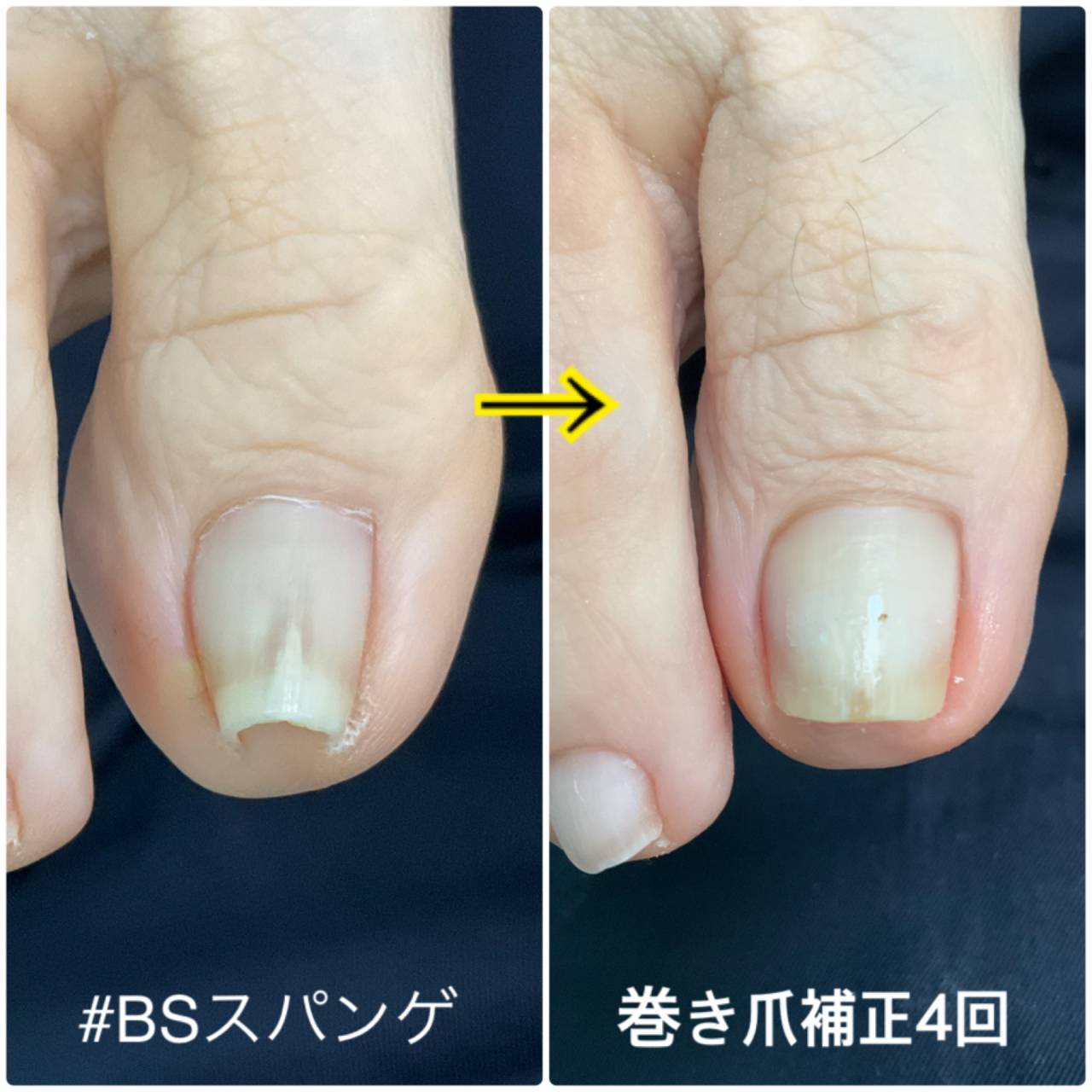 巻き爪補正BSスパンゲ 巻き爪のお悩みは宜野湾市の爪ケア専門店へ