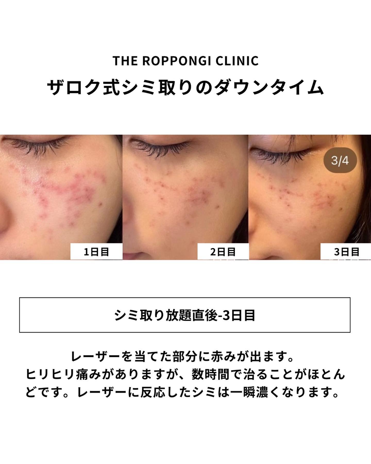 テープ不要のシミ取り】ピコレーザーのダウンタイム大公開 のビフォー