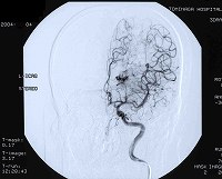 脳動静脈奇形（AVM）－脳神経外科医 富永紳介