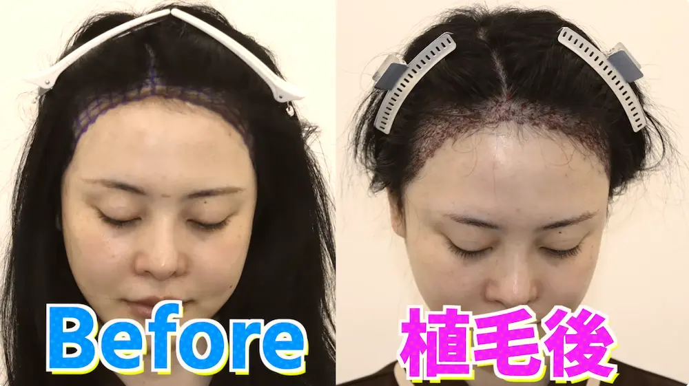 インフルエンサー「レイ」さんの植毛施術当日に密着｜美容植毛の