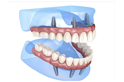 オールオン4 難症例 骨造成インプラント | 千葉県松戸市 常盤平駅