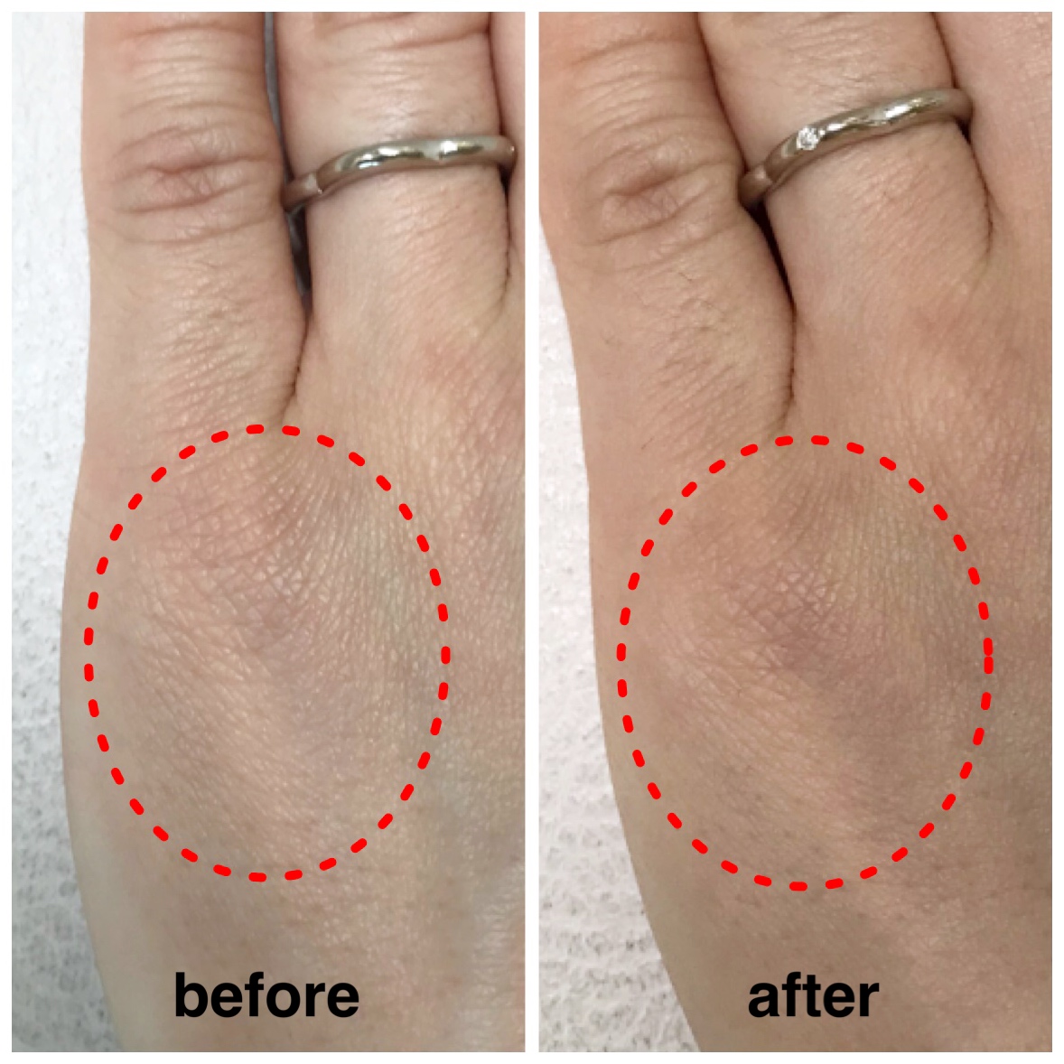 塗るボトックス《リボックス7》を手に塗ってみた | 福岡市城南区の