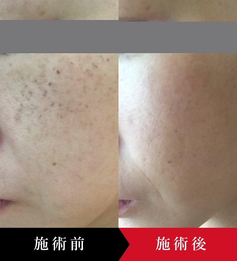 しみ・肝斑・そばかすの症例｜椿クリニック 銀座・名古屋・心斎橋