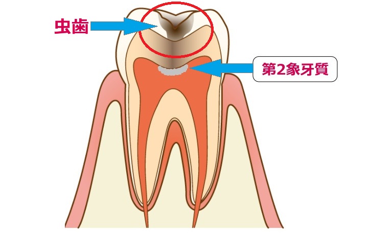 治療したらしみる… | 高崎市椿町の歯医者 内田デンタル - 高崎の街中に