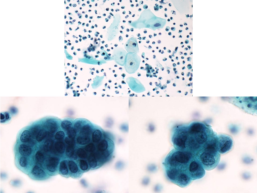 第13回 スライドカンファレンス症例 ｜ 泌尿器細胞診(別府)カンファレンス