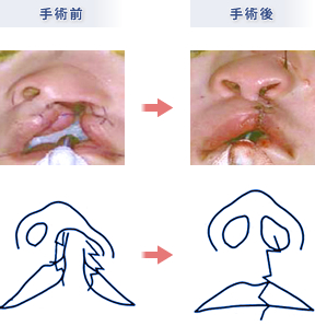 口唇口蓋裂の外科治療 | 大阪大学大学院 歯学研究科 口腔外科学第一教室