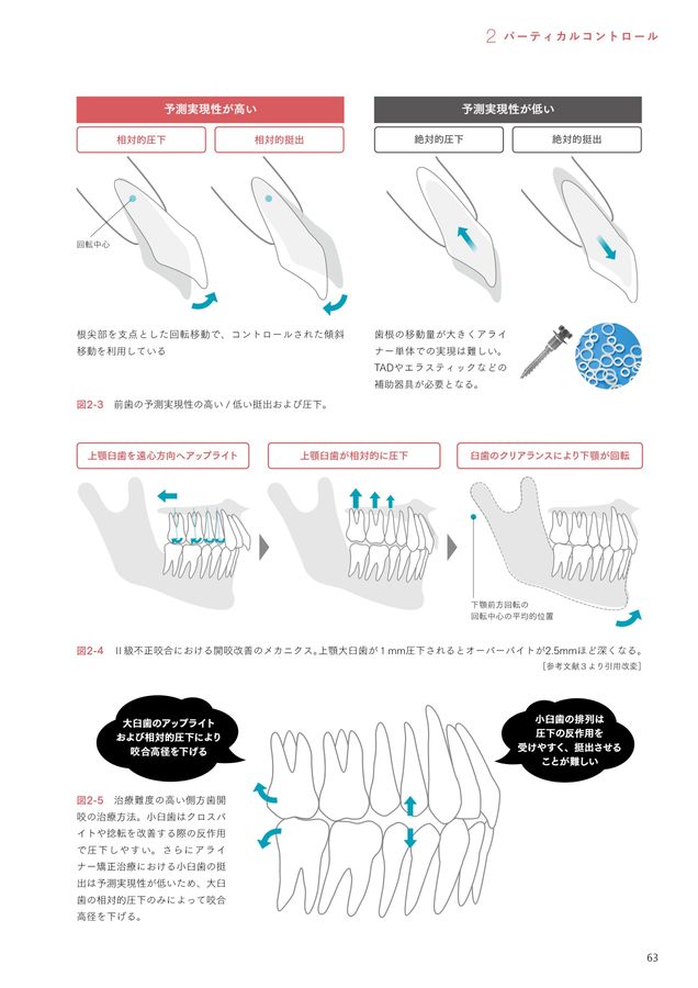 アライナー矯正治療戦略
