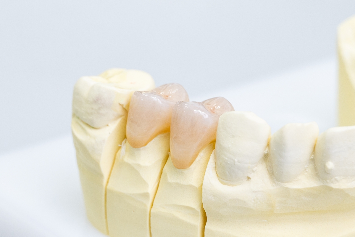 セラミック治療のご相談は心斎橋の歯医者『ウェルネスデンタルクリニック』