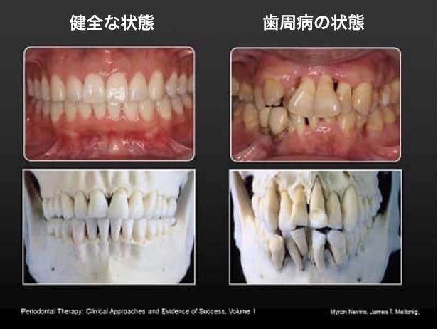 歯周組織再生治療法 | 水天宮前・人形町の歯医者・歯科医院