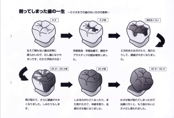 あなたの第一大臼歯は、4本ありますか？ | ライフ・デンタル