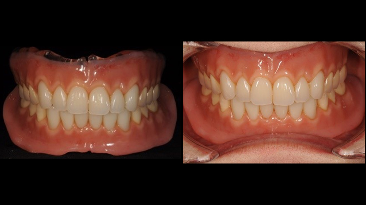義歯（GDSデンチャー） | セント歯科 - 大分県別府市の歯医者さん歯周
