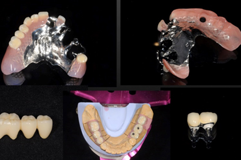 義歯（GDSデンチャー） | セント歯科 - 大分県別府市の歯医者さん歯周