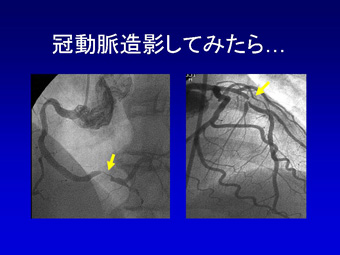 検査と治療について」患者の皆さま｜徳島大学病院循環器内科