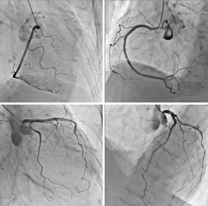 心臓カテーテル検査