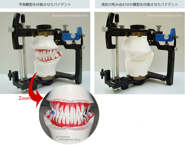 咬合器について｜赤羽矯正歯科｜日本矯正歯科学会（認定）専門医,舌側