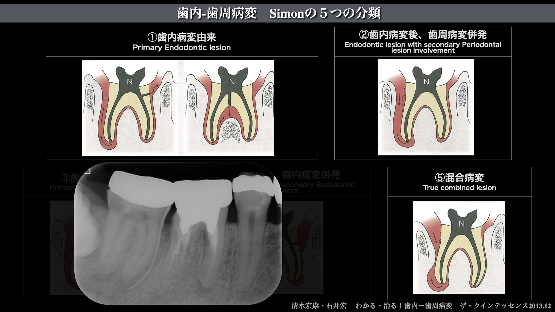 歯内-歯周(エンドペリオ)病変に罹患した歯の治療｜福岡市東区香椎浜の