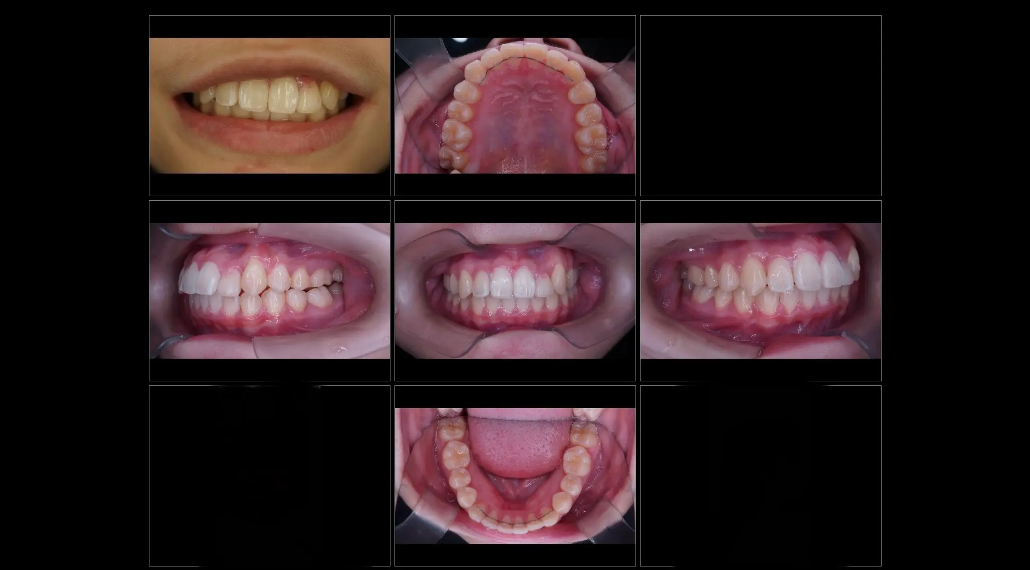 16歳八重歯の非抜歯ワイヤー矯正 症例 | 世田谷区桜新町 グリーン歯科