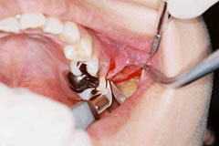 医療従事者の方へ：口腔外科手術の基本的手技（上顎埋伏智歯抜歯