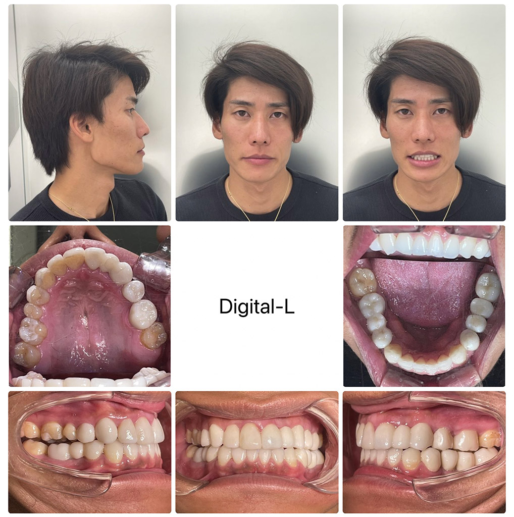 DIGITAL-L歯科・矯正歯科｜歯並びのお悩みを、マウスピース型装置