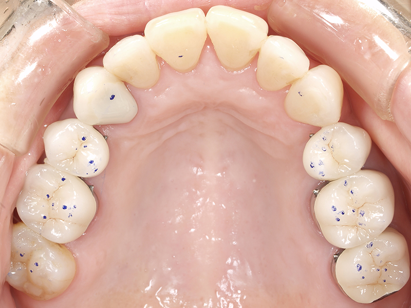 事例紹介 | デンタルラボ スカーラ Dental Lab SCALA 名古屋市中川区の