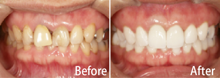 インプラント審美修復｜たかむら歯科・小児歯科武