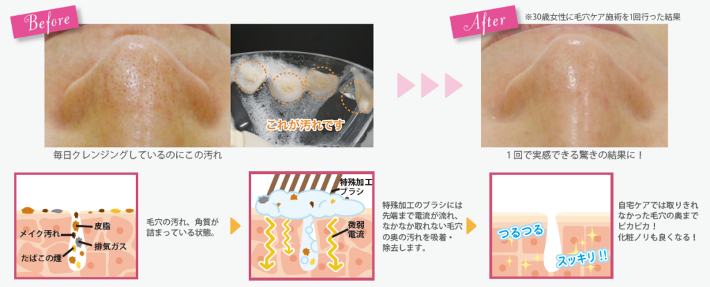 SPセルース×毛穴エレクトロブラシ ～水素のチカラがあなたのお肌を