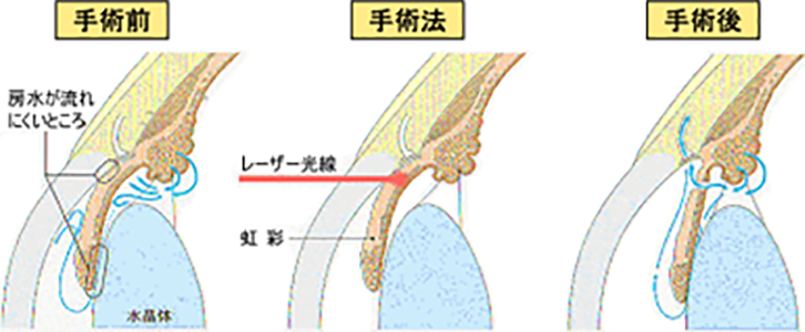 原発性閉塞隅角症/閉塞隅角緑内障/急性緑内障発作 | えのき眼科｜埼玉