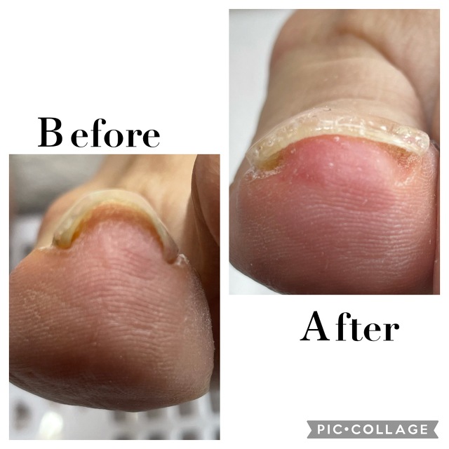 巻き爪矯正 ペディグラス - 広島 フットケア・魚の目・タコ・巻き爪