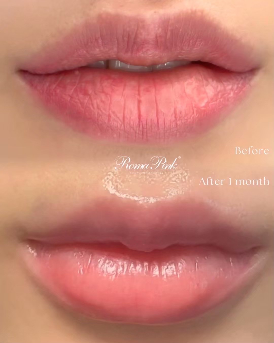 ローマピンク（Roma Pink）｜美容皮膚科エルムクリニック