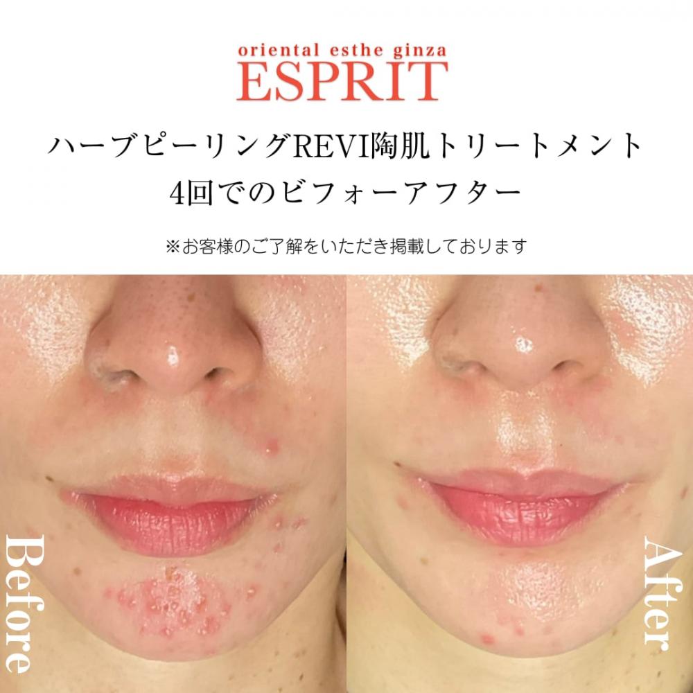 ハーブピーリングREVI【ルヴィ】陶肌トリートメント ｜東京銀座、新宿